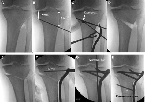 A Novel Closed Wedge High Tibial Osteotomy Procedure To Treat