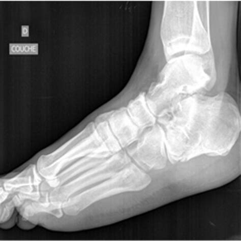 Ap Lateral And Axial Views Of The Ankle Joint Showing Calcaneal