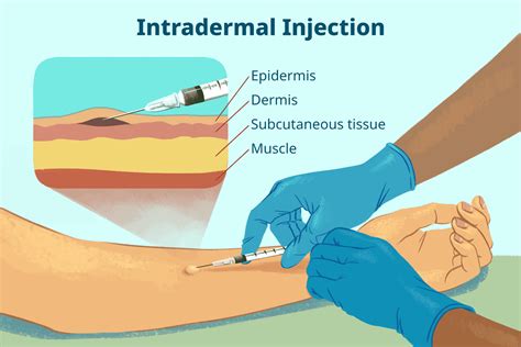 Image Result For Intradermal Subcutaneous Injection Dermis Epidermis