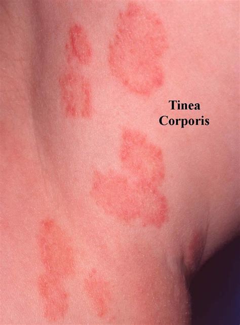 Ringworm Tinea Causes Signs Symptoms Diagnosis And Treatment