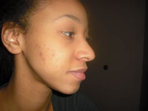 Journey To Beautiful Acne Scarring And Hyperpigmentation