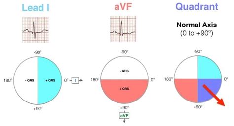 Right Axis Deviation Ecg Diagnosis Article Blog