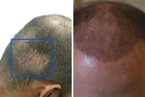 Top Hair Transplant Months Results Camera Edu Vn
