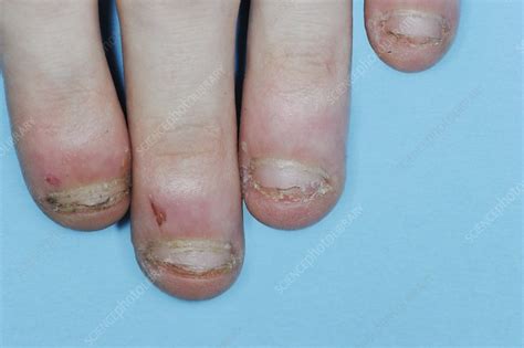 Chronic Nail Biting Stock Image C0095271 Science Photo Library