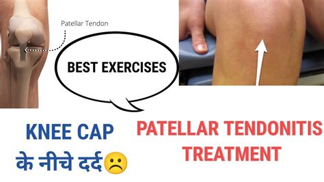 Patellar Tendonitis Exercises Knee Pain While Jumping Pain Below