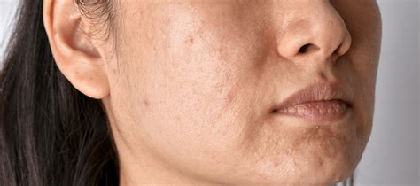 Skin Discoloration Causes Of Skin Discoloration On Face The Pink Foundry