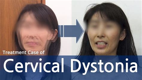 Dystonia Cervical Dystonia Spasmodic Torticollis 사경증 치료사례 근긴장
