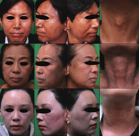 Clinical Photographs Pigmentation Was Prominent On Lateral Face