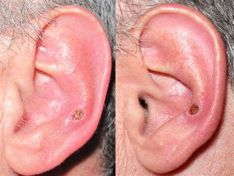 Basal Cell Carcinoma On My Left Ear Not Sure Of How Far I Flickr
