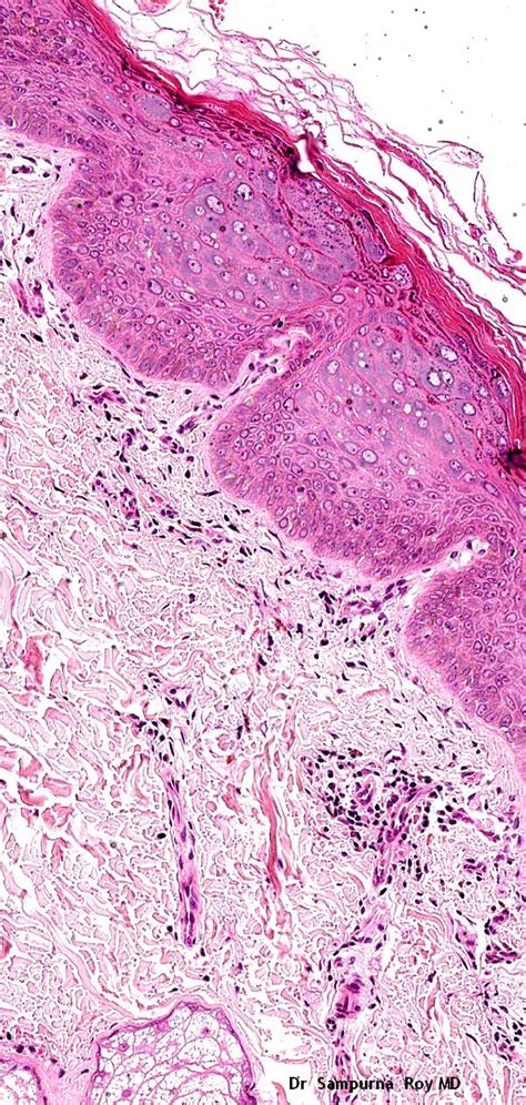 Pathology Of Epidermodysplasia Verruciformis Pathology Cancer Of The Skin Squamous Cell