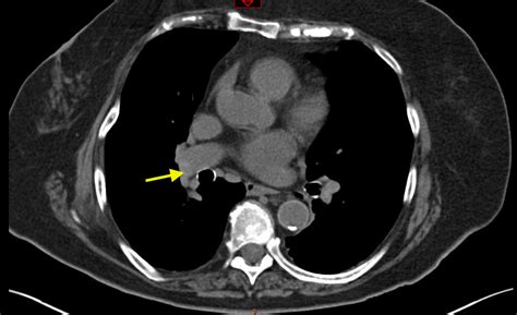 Pulmonary Embolism Diagnosis By Computerized Tomography Without