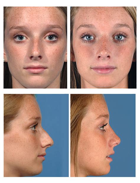 Rhinoplasty Before And After Photos