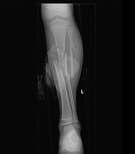 Compound Fractures X Ray