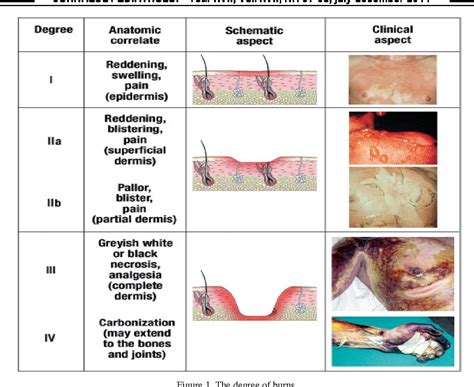 Figure 1 From Pediatric Burns And Scalds Modern Therapeutic Concepts