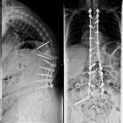 A 64 Year Old Woman Underwent Posterior Spinal Fusion From T3 To The Download Scientific