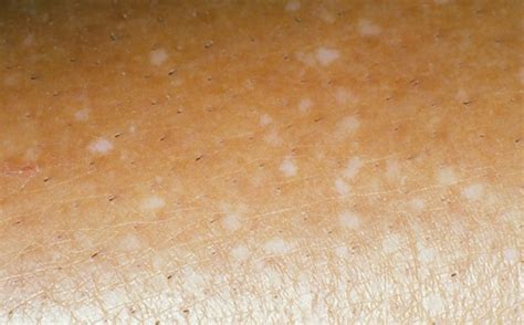 Small White Spots On Arms And Legs Idiopathic Guttate
