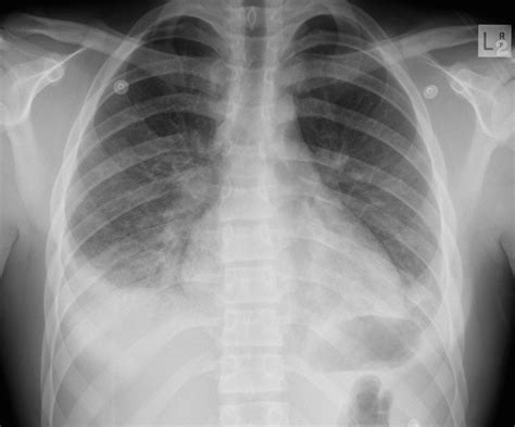 Kermany, michael goldbaum, wenjia cai, m. Pneumonia Case 001 • LITFL • Ultrasound library clinical case