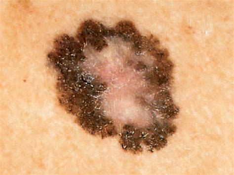 Skin Cancer Could Be Hiding Where Youd Never Expect The Sole Of Your