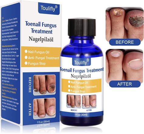 What To Expect Fungal Nail Infections Bosco Productions