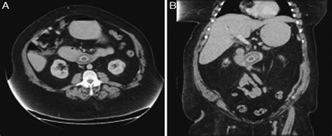 Bouveret Syndrome Gallstone Ileus Of The Duodenum Surgical