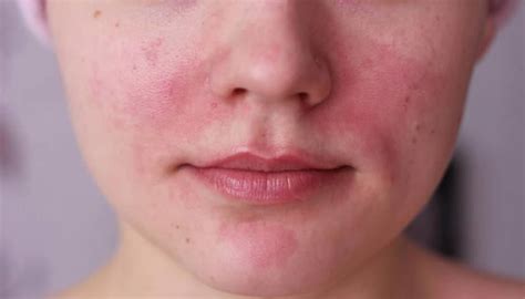 How To Treat Acne Rosacea Languagede Acne Or Rosacea Azeco