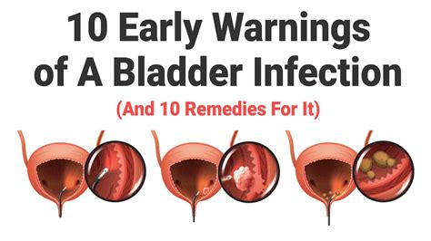 Bladder Infection Pictures