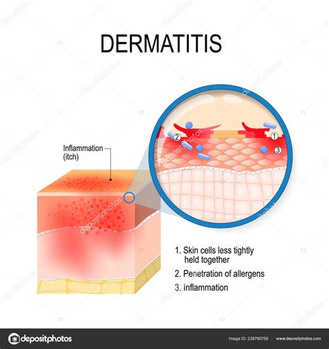 Atopic Dermatitis Atopic Eczema Cross Section Human Skin Dermatitis