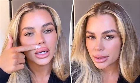 Big Brother Star Skye Wheatley Reveals She Is Getting Her Lip Filler Dissolved Daily Mail