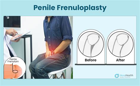 Penile Frenuloplasty Purpose Side Effects And Success Rate
