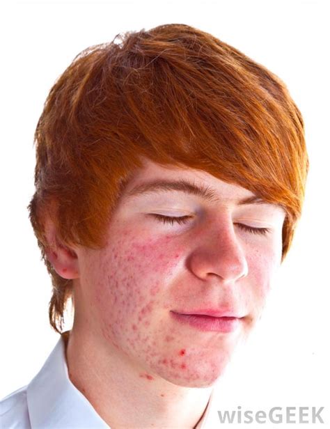 Teen With Acne Dorothee Padraig South West Skin Health Care