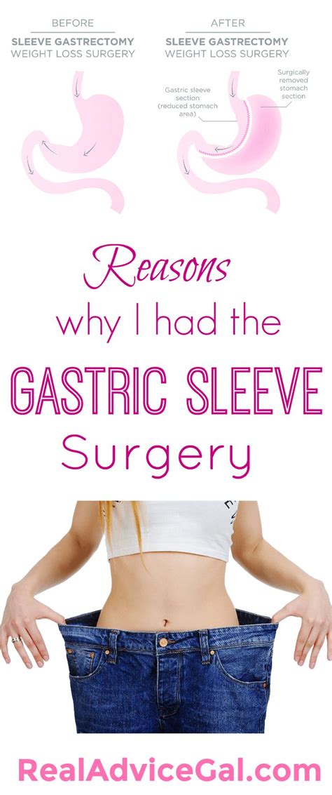 Why I Had The Gastric Sleeve Surgery Real Advice Gal Sleeve Surgery