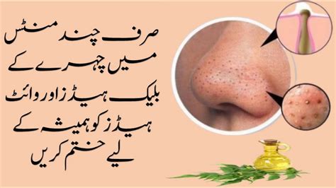 How To Remove Blackheads Instantly At Home Nose Blackheads Removal