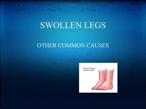 Ppt Swollen Legs Powerpoint Presentation Free Download Id5189270