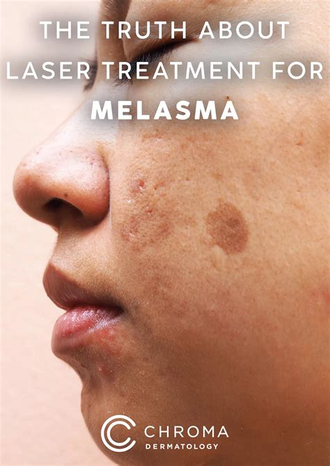 The Truth About Laser Treatment For Melasma Chroma Dermatology