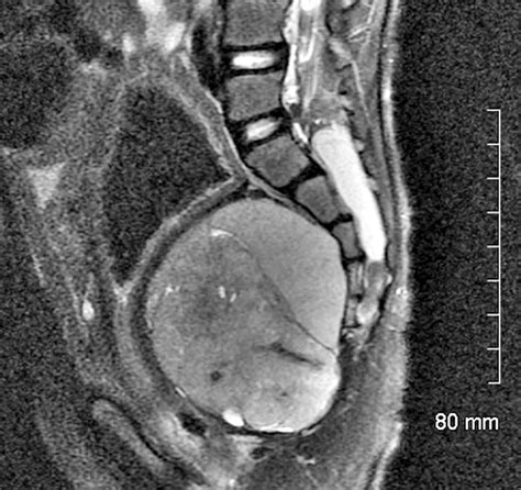 Presacral Masses Multimodality Imaging Of A Multidisciplinary Space