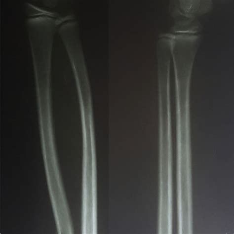 Pre Operative Radiograph Download Scientific Diagram