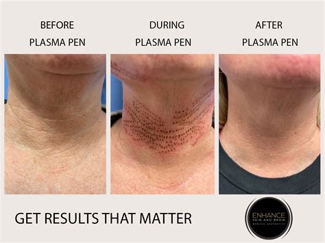 Plasma Pen Treatment Fibroblasting Enhance Skin And Brow