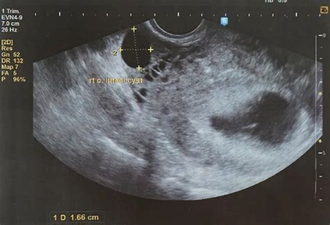 5 weeks pregnant ultrasound scan