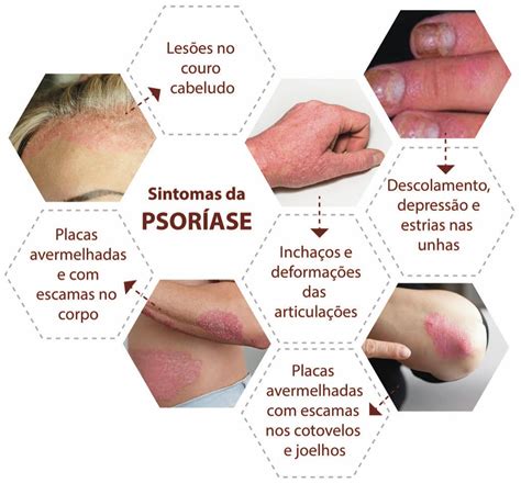 O Que é Psoríase Fotos Da Doença