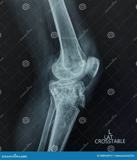 X Ray Left Knee Lateral View Avulsion Fracture Tibial Tubercle