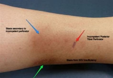 Blood Clot In Leg Symptoms Signs Causes Diagnosis Treatment