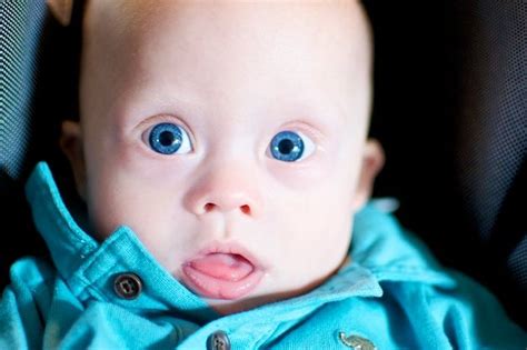 Surgery can help with these problems. down-syndrome-baby-cute-eyes | Deus esta aqui