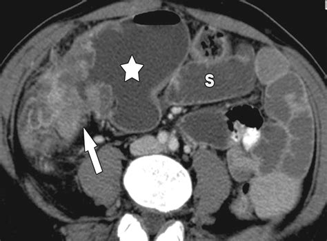 Small Bowel Obstruction What To Look For Radiographics
