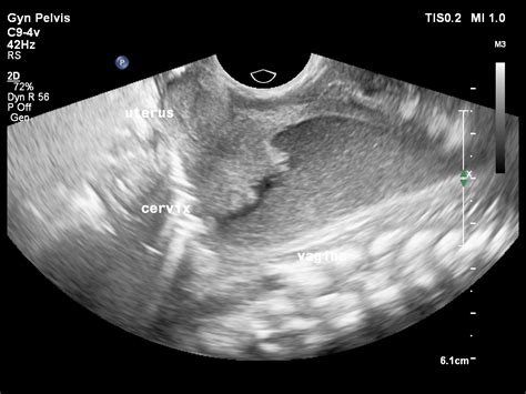 Imperforate Hymen In Newborn Image