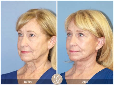 Neck Lift 413 Before After Photos Orange County