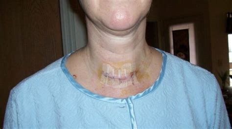 Heres What To Expect After Thyroid Surgery My Post Thyroid Surgery