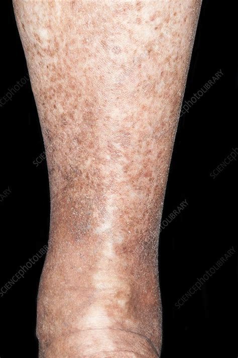 Varicose Eczema Stock Image C0197747 Science Photo Library