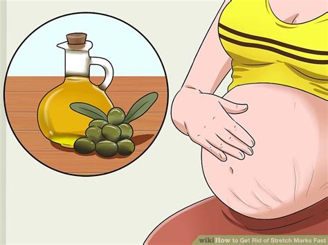 Ways To Get Rid Of Stretch Marks Fast Wikihow