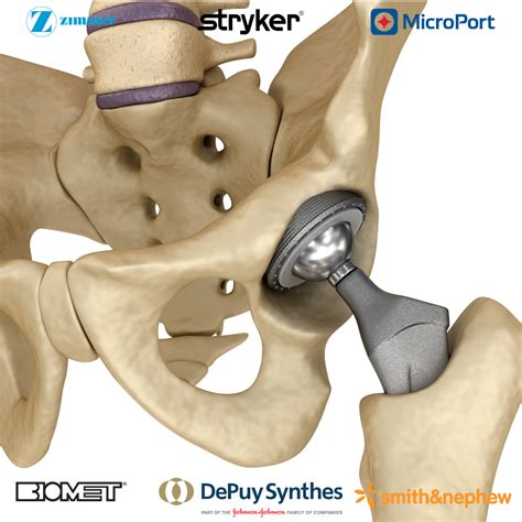 Metal Hip Implant Recall Lawyer Schmidt National Law Group