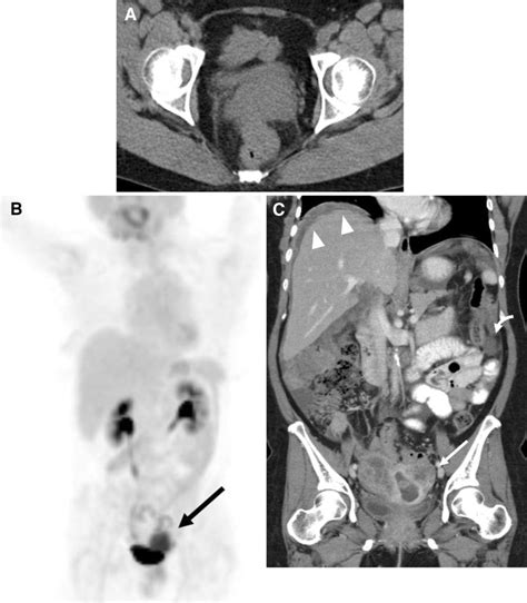 48 Year Old Woman Presenting With Abnormal Vaginal Discharge And Pelvic Download Scientific